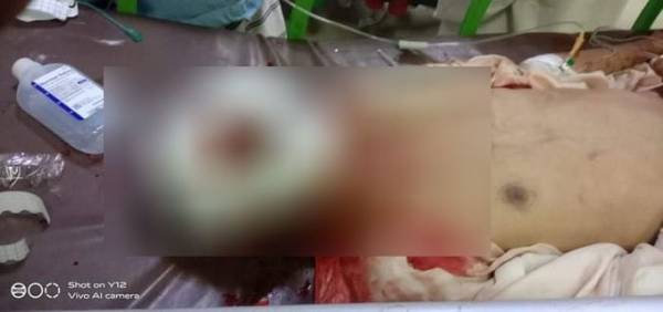 حجة.. مسلحون نافذون يدهسون مواطناً بعد جلسة محاكمة بقضية سرقة اغنام